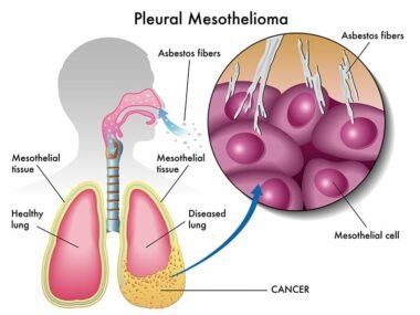 Monroe Mesothelioma Legal Question