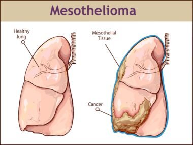 Columbia Mesothelioma Legal Question