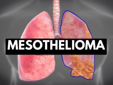 Massachusetts Mesothelioma Legal Question