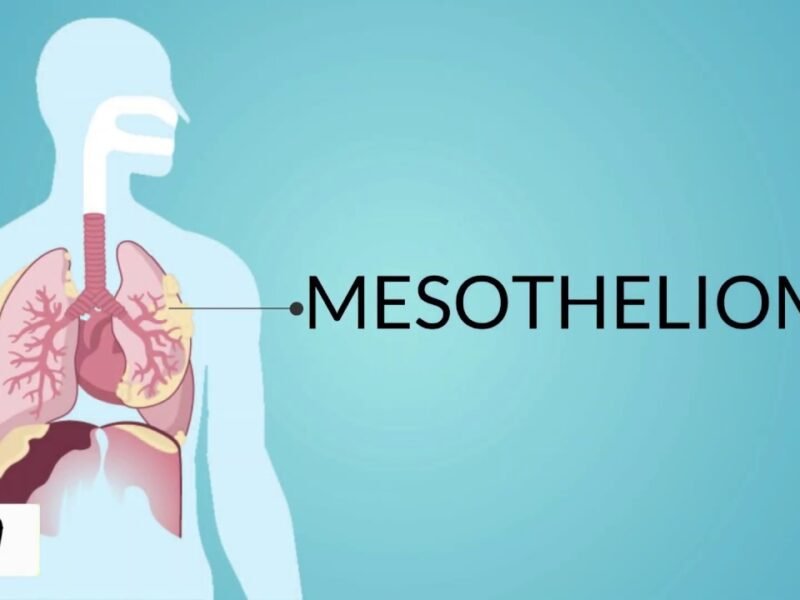 Charleston Mesothelioma Legal Question